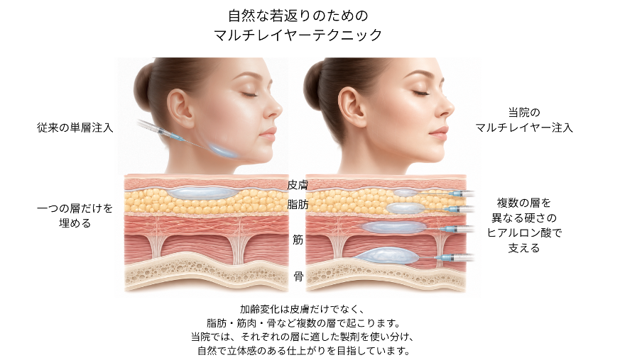マルチレイヤーテクニック