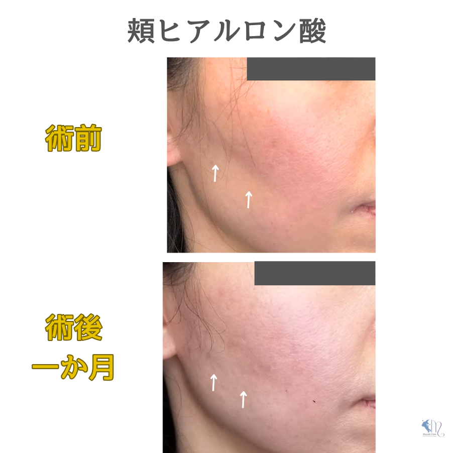 頬(ほほ)のヒアルロン酸注入イメージ