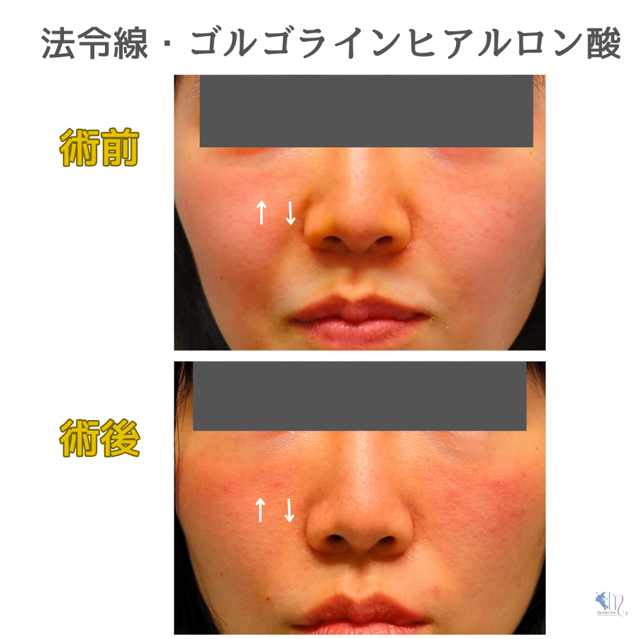 ゴルゴラインのヒアルロン酸注入イメージ