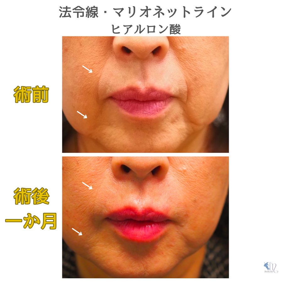 ほうれい線のヒアルロン酸注入イメージ