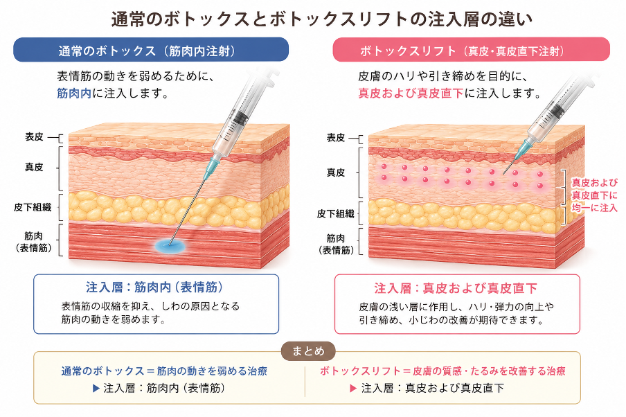 ボトックスリフト
