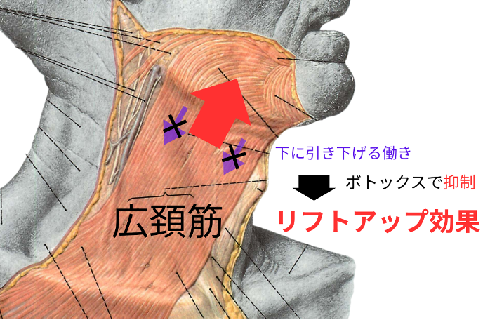 ボトックスリフトの効果