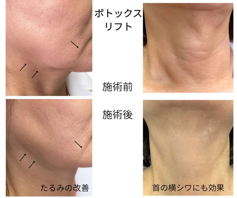 ボトックスリフトの効果